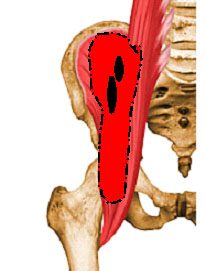 caso_agosto_5 Representación gráfica anatómica de la pelvis con localización del sangrado con áreas liquidas de aspecto quístico en negro y hemorragia aguda en rojo en musculo psoas iliaco der.